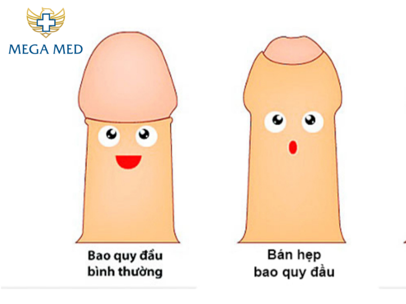 Hiện tượng bán hẹp bao quy đầu